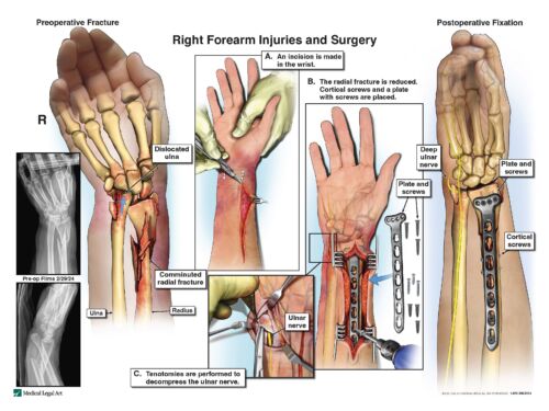 $300,000 Settlement Secured After Athens, Georgia Car Accident Causes Serious Wrist Injury